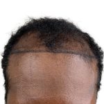 Hair Transplants Before & After Patient #3755
