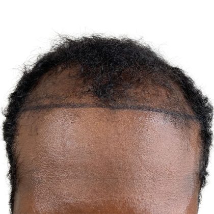Hair Transplants Before & After Patient #3755