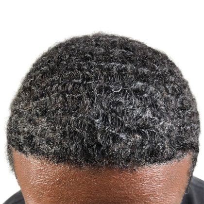 Hair Transplants Before & After Patient #3755
