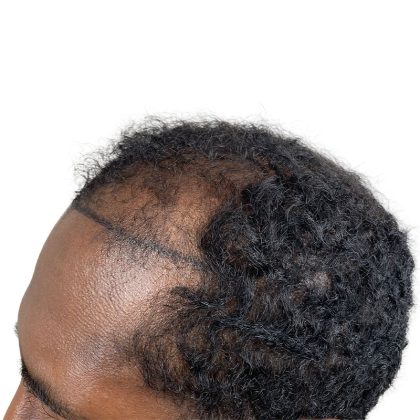 Hair Transplants Before & After Patient #3755