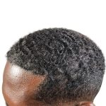 Hair Transplants Before & After Patient #3755