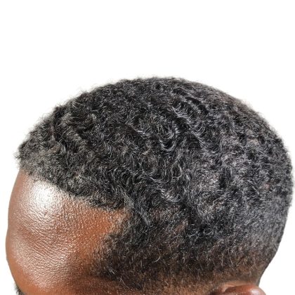 Hair Transplants Before & After Patient #3755