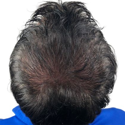 Hair Transplants Before & After Patient #3607