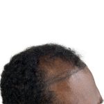 Hair Transplants Before & After Patient #3755