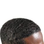 Hair Transplants Before & After Patient #3755