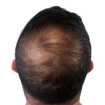 Hair Transplants Before & After Patient #3608