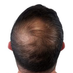 Hair Transplants Before & After Patient #3608