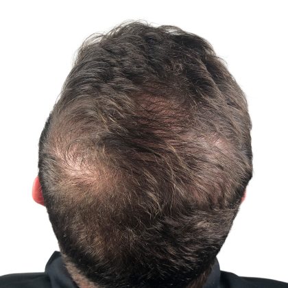 Hair Transplants Before & After Patient #3608