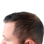 Hair Transplants Before & After Patient #3608