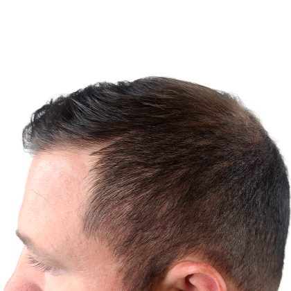 Hair Transplants Before & After Patient #3608