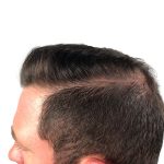 Hair Transplants Before & After Patient #3608