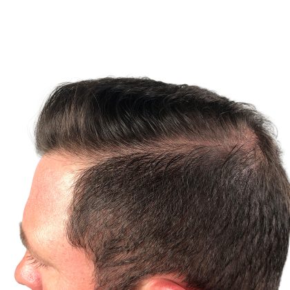 Hair Transplants Before & After Patient #3608