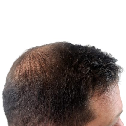 Hair Transplants Before & After Patient #3608