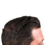 Hair Transplants Before & After Patient #3608