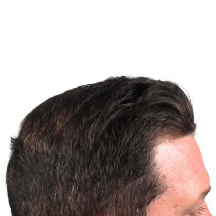 Hair Transplants Before & After Patient #3608