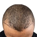 Hair Transplants Before & After Patient #3534