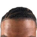 Hair Transplants Before & After Patient #3534