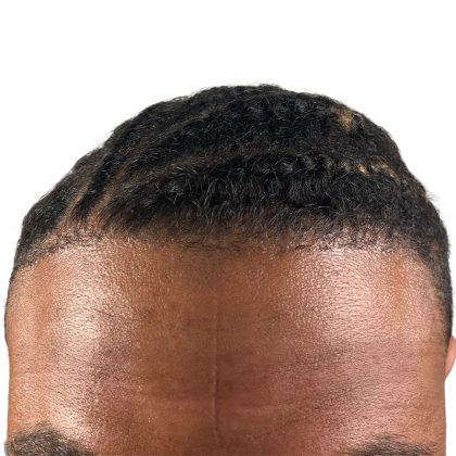 Hair Transplants Before & After Patient #3534
