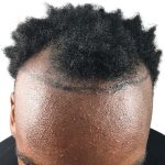 Hair Transplants Before & After Patient #3609