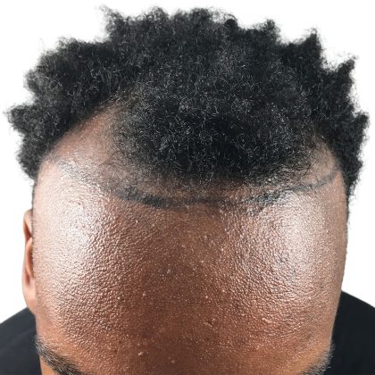 Hair Transplants Before & After Patient #3609