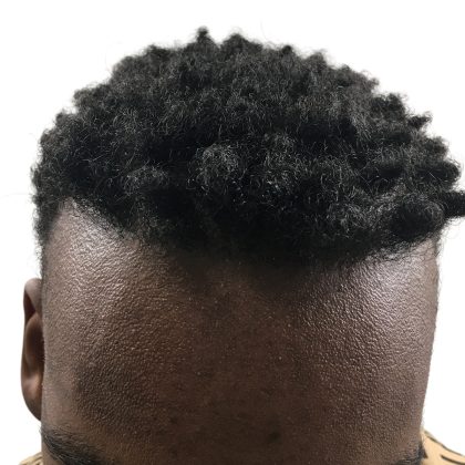 Hair Transplants Before & After Patient #3609