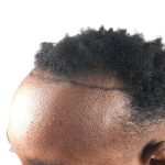 Hair Transplants Before & After Patient #3609