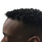 Hair Transplants Before & After Patient #3609