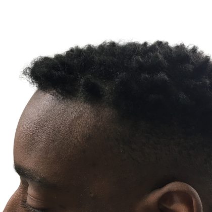 Hair Transplants Before & After Patient #3609