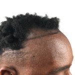 Hair Transplants Before & After Patient #3609