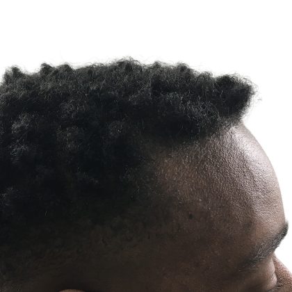 Hair Transplants Before & After Patient #3609