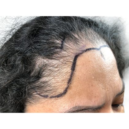 Hair Transplants Before & After Patient #3649