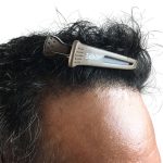 Hair Transplants Before & After Patient #3610