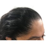 Hair Transplants Before & After Patient #3649
