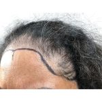Hair Transplants Before & After Patient #3649