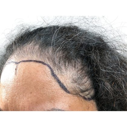 Hair Transplants Before & After Patient #3649