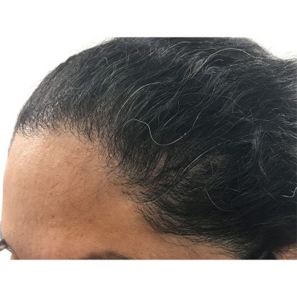 Hair Transplants Before & After Patient #3649