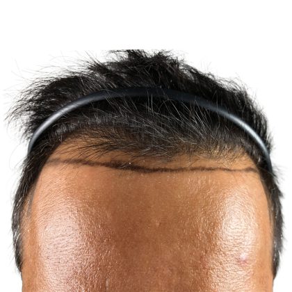 Hair Transplants Before & After Patient #3610
