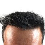 Hair Transplants Before & After Patient #3610