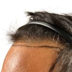 Hair Transplants Before & After Patient #3610