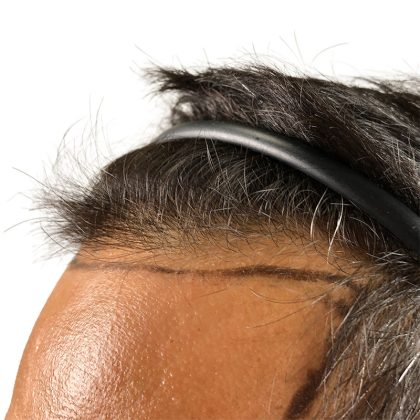 Hair Transplants Before & After Patient #3610