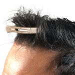 Hair Transplants Before & After Patient #3610