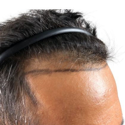 Hair Transplants Before & After Patient #3610