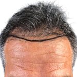 Hair Transplants Before & After Patient #3611