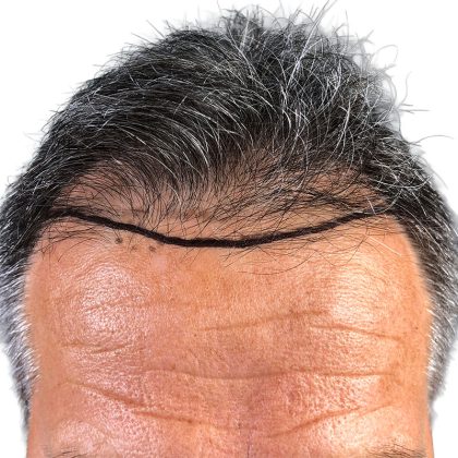 Hair Transplants Before & After Patient #3611