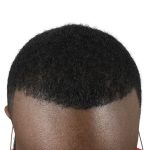 Hair Transplants Before & After Patient #3648