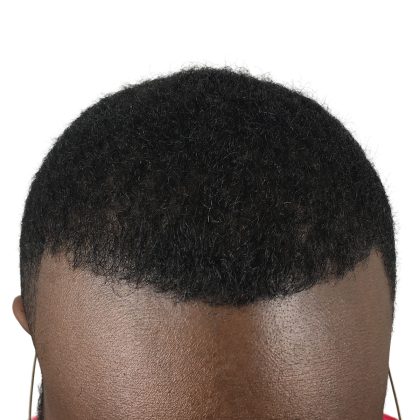 Hair Transplants Before & After Patient #3648