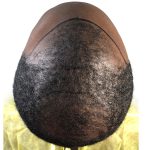 Hair Transplants Before & After Patient #3648