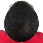 Hair Transplants Before & After Patient #3648