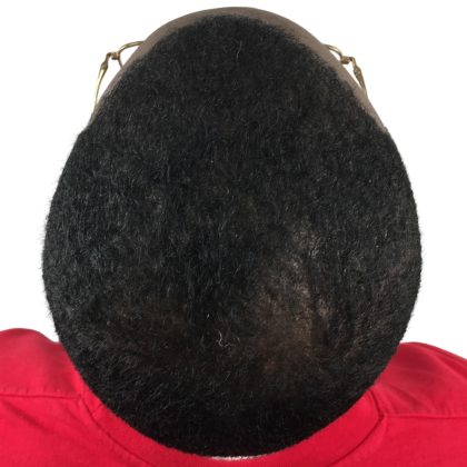 Hair Transplants Before & After Patient #3648