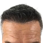 Hair Transplants Before & After Patient #3611